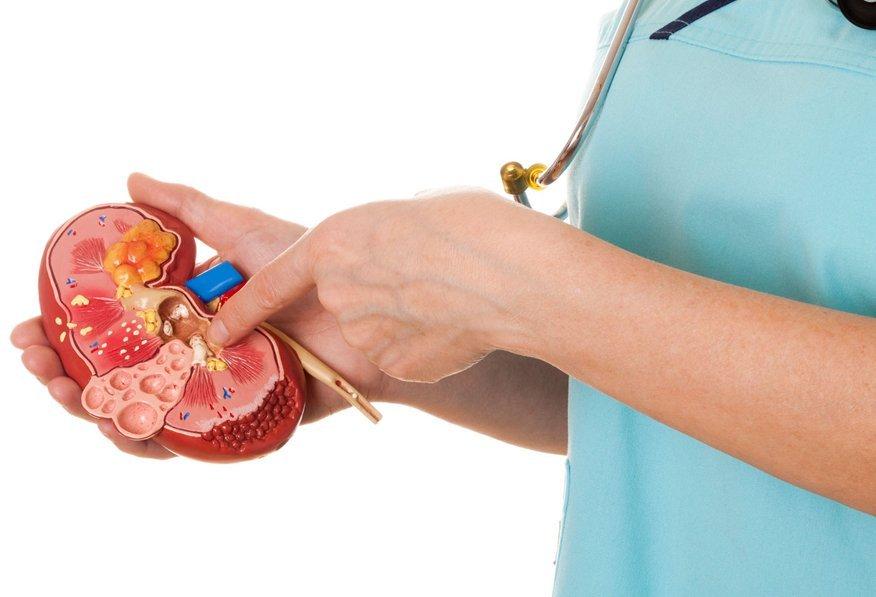 Kidney Stones Dr. John KC