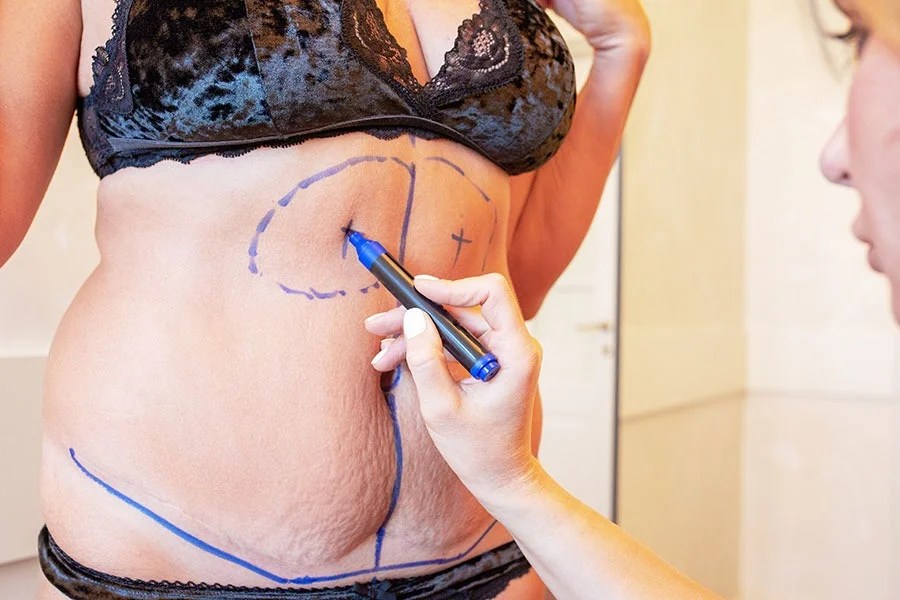 Retrouver un ventre plat grâce à l’abdominoplastie | Dr HADDAD | Paris