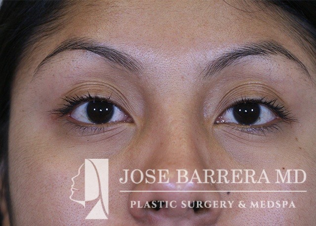 Blepharoplasty Case 3744 Dr. Jose Barrera San Antonio Facial Plastic