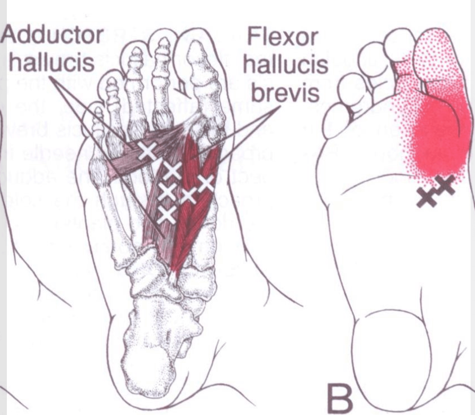 Adductor Hallucis Weakness Causes Painful toes, Arch and Creates