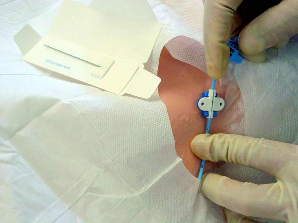 External Jugular Vein Catheterization « Review of Critical Care Medicine