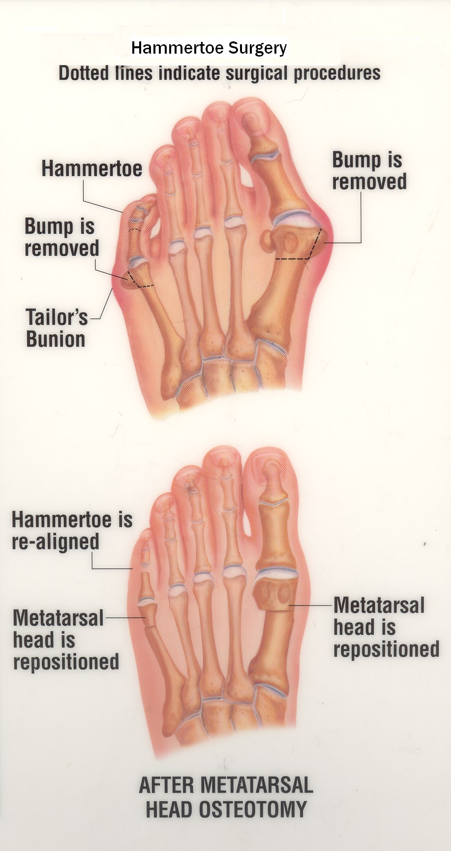 Hammertoe