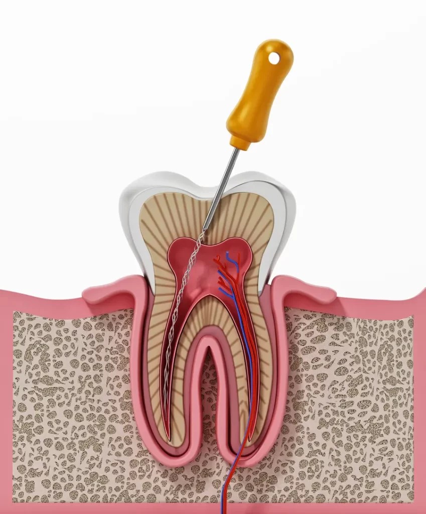Root Canal Therapy in Northridge Kevin H Gropp, DDS