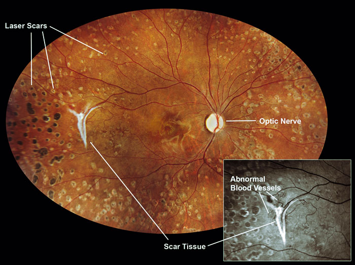 Lupus Eye Picture Harmony EyeCare Center Dr. David Kisling Fort