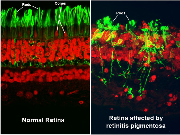 Peripheral Side Vision Loss Retinitis Pigmentosa Harmony EyeCare