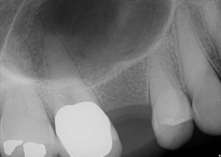 Understanding Sinus Lift in Dental Implant Surgery