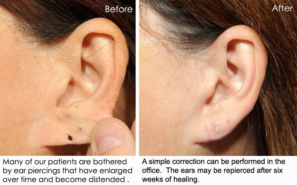 Earlobe Repair, Mole Removal & Misc Before & After Gallery Dr