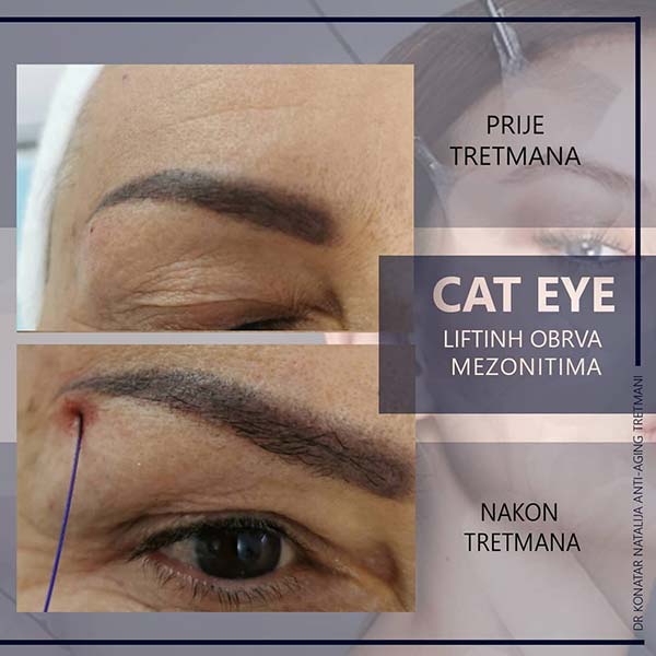 CAT EYES Lifting obrva mezonitima dr Konatar