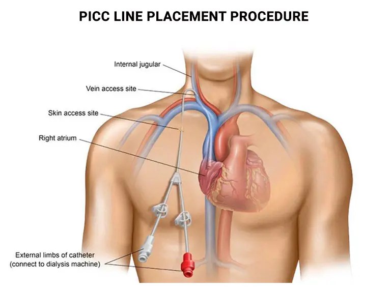 PICC line Placement Dr Konika