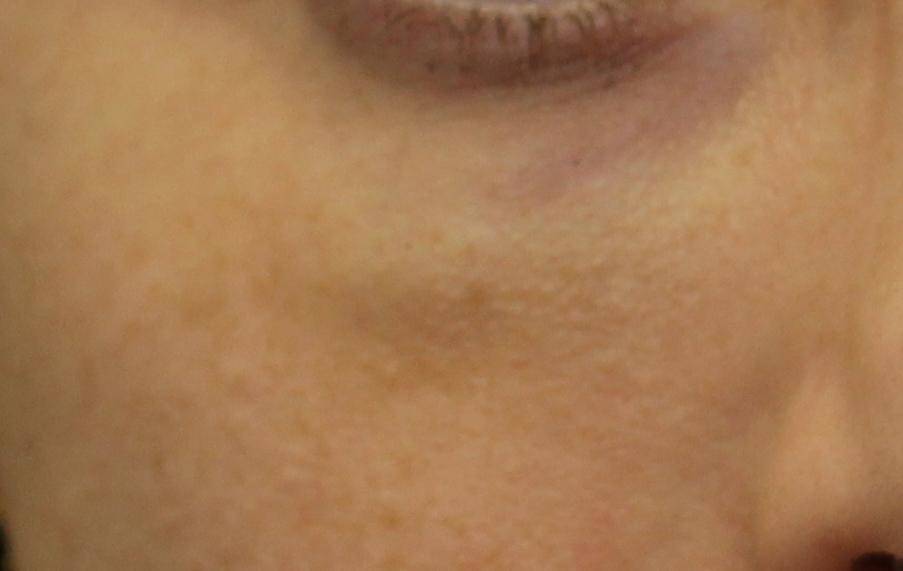 The Fix: puffy under eyes after filler injection - Brett Kotlus M.D.
