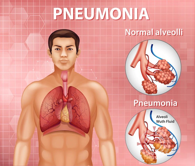 Best Pneumonia Treatment in Hyderabad Pneumonia Specialist