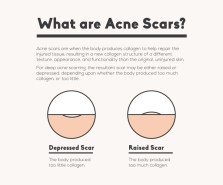 Prevent Acne Scarring