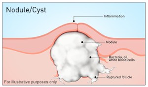 causes of acne nodule and treatment 