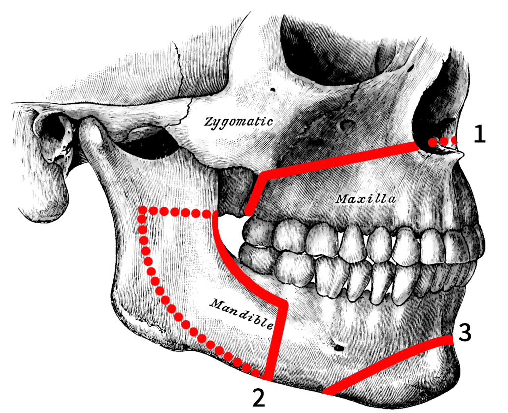 How to Recognize the Early Warning Signs of Jaw Revision Surgery