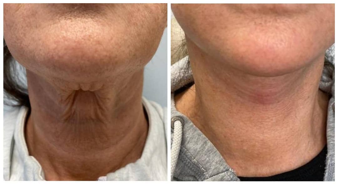 Mini Face Lift Boston Weymouth MA New England Cosmetic Surgery