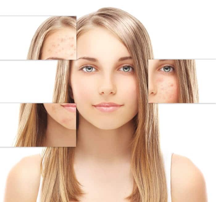 Benefits of the SmoothBeam Laser Treatment Boston Weymouth MA New