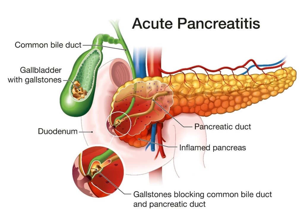 Acute Pancreatitis Treatment In Singapore LS Lee Surgery Clinic