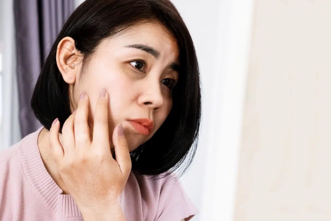 Dark Eye Circles Removal in Singapore Dr Lee Mun Heng