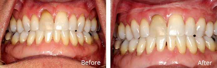 Cosmetic Gum Surgery in Melbourne FL Lee Sheldon, DMD, PA