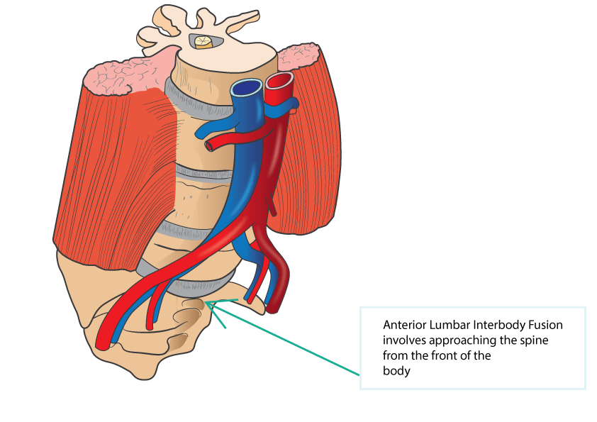 Minimal Invasive Anterior Lumbar Interbody Fusion (ALIF) Dr Yu Chao Lee
