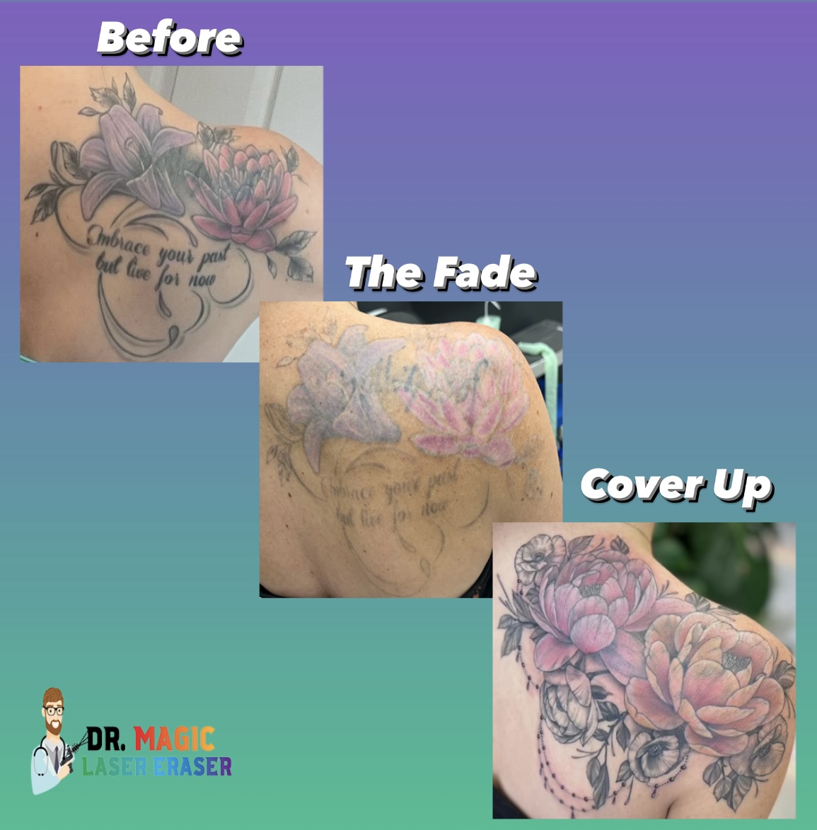 Dr Magic Laser Eraser Tattoo Removal