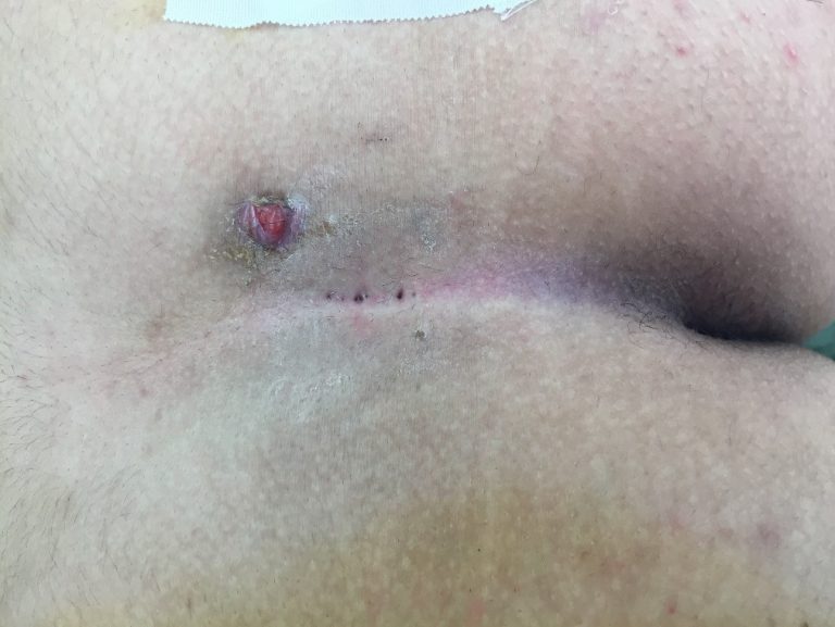 Pilonidal Wound Care Maher A. Abbas. MD Proctology. Colonoscopy