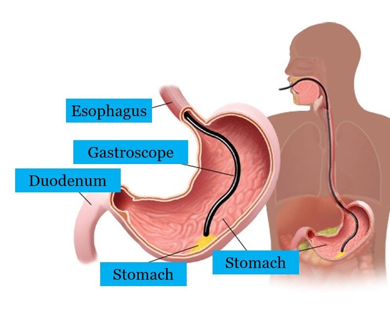 Gastroscopy [Upper Endoscopy] Maher A. Abbas, MD Dubai/UAE