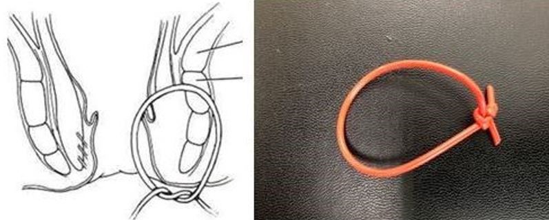 Minimally Invasive Procedures for Fistula Maher A. Abbas. MD Dubai
