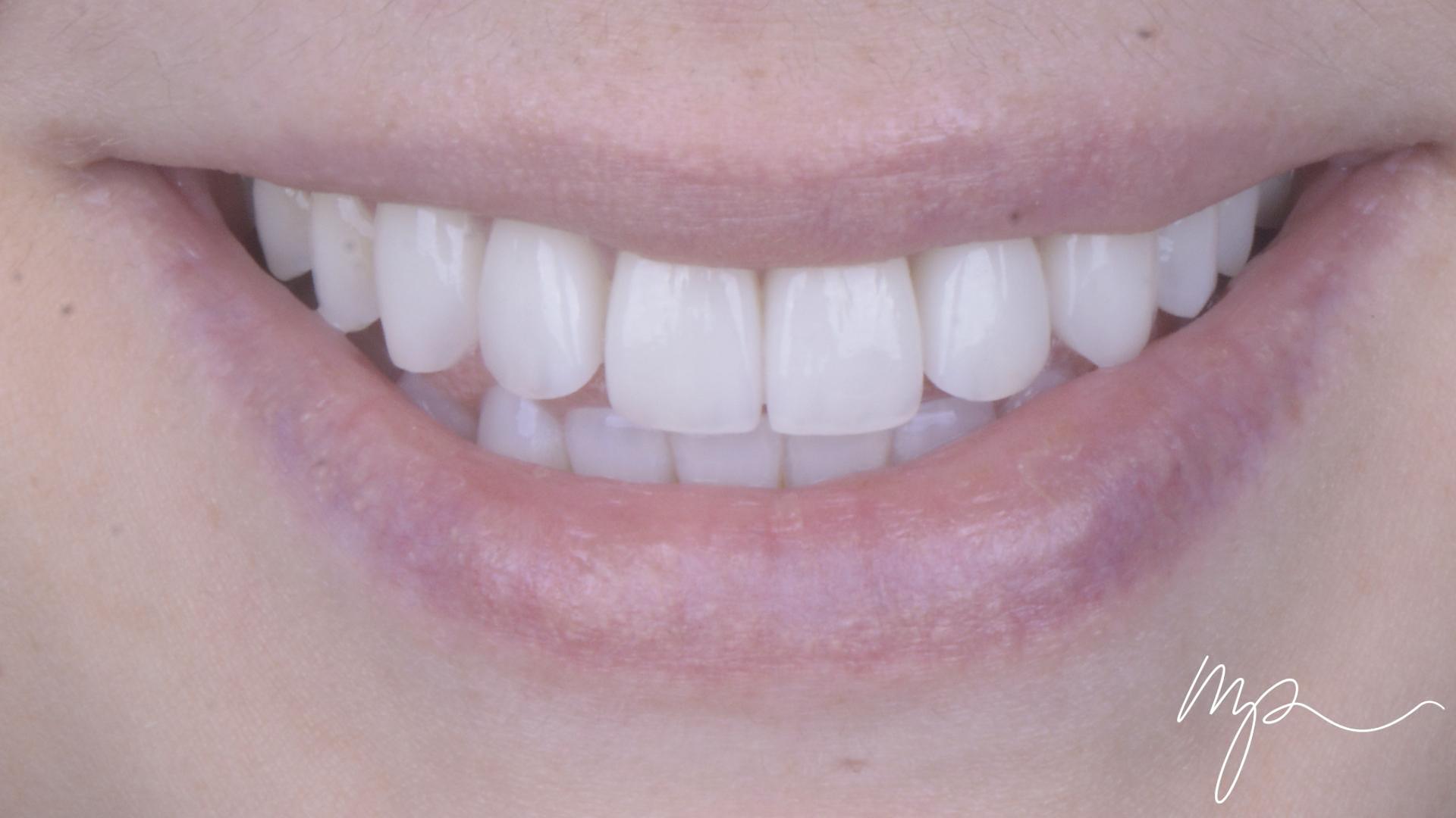 Galerie Avant Après Dr Marin Pomperski Chirurgien Dentiste