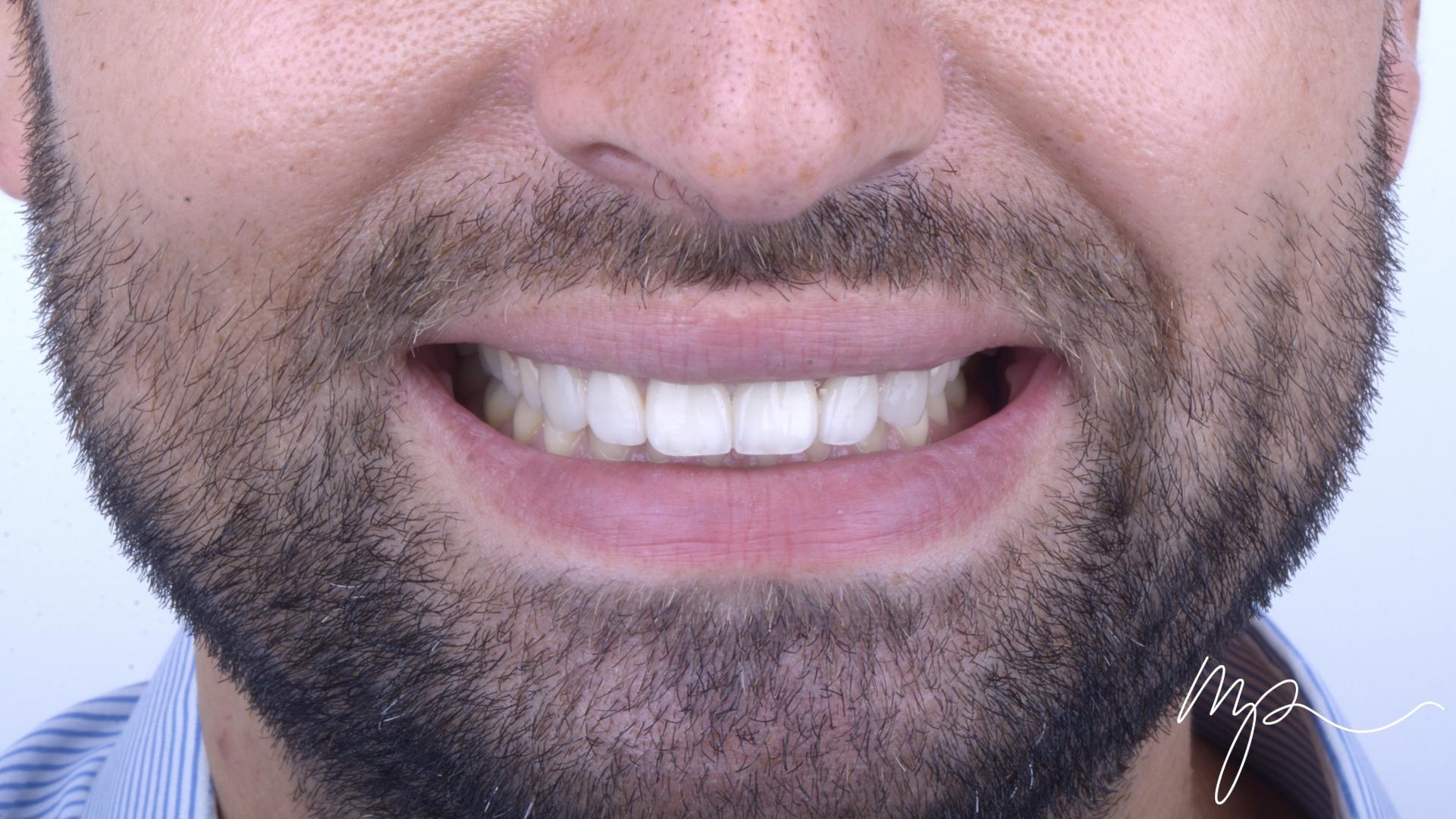 Galerie Avant Après Dr Marin Pomperski Chirurgien Dentiste