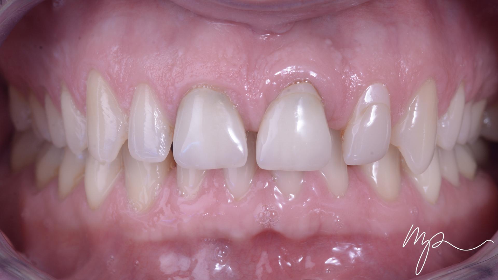 Galerie Avant Après Dr Marin Pomperski Chirurgien Dentiste