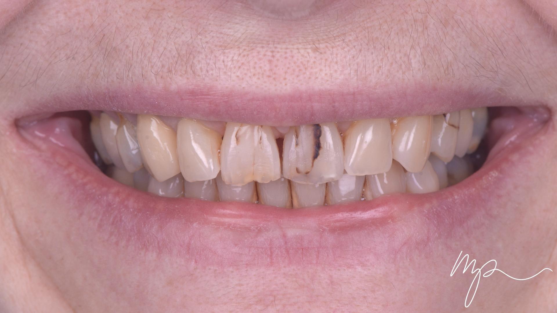 Galerie Avant Après Dr Marin Pomperski Chirurgien Dentiste