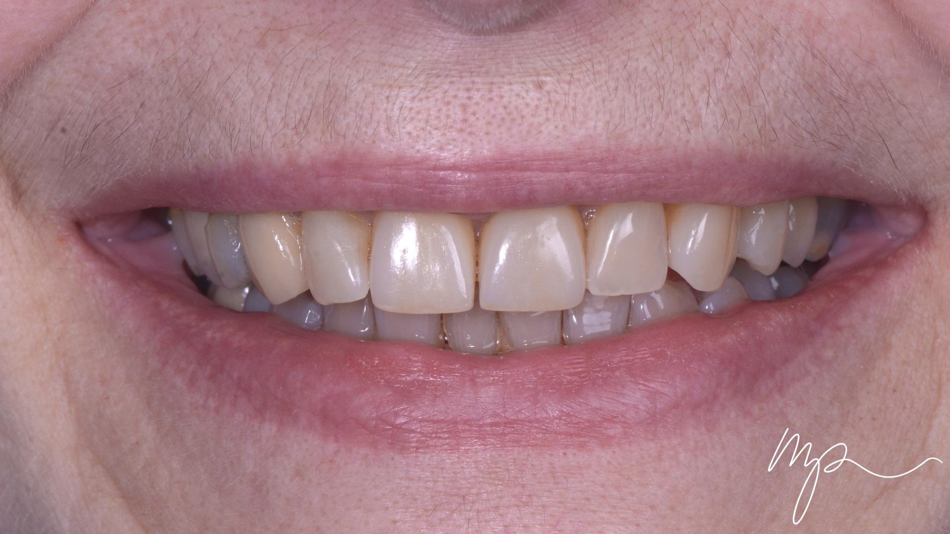 Dentisterie Esthétique Dr Marin Pomperski Chirurgien Dentiste