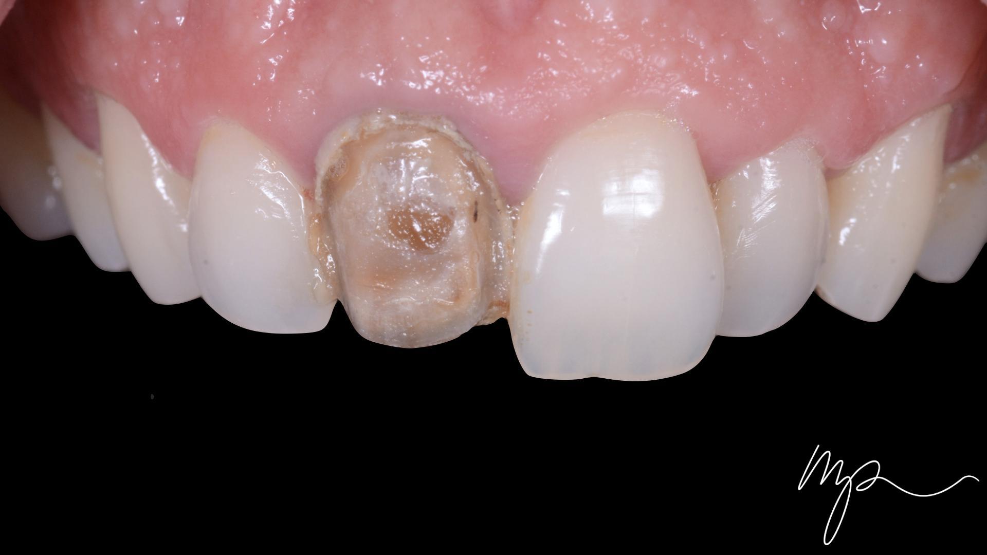 Dentisterie Esthétique Dr Marin Pomperski Chirurgien Dentiste