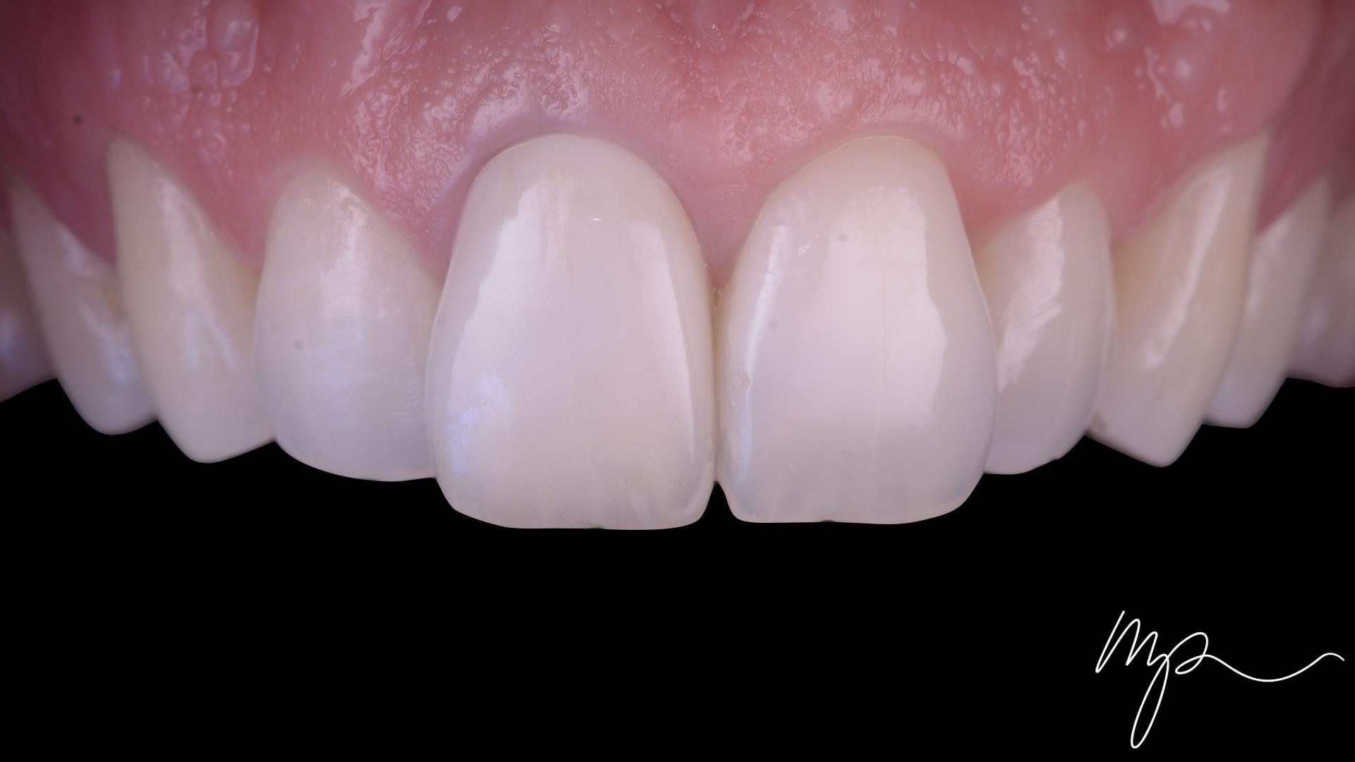 Dentisterie Esthétique Dr Marin Pomperski Chirurgien Dentiste