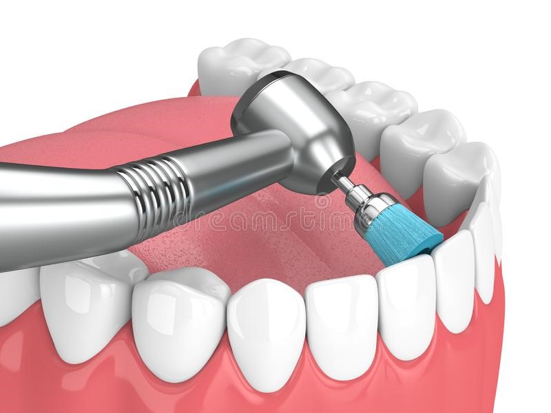 پولیش دندان طبیعی دكتر مريم افشاری متخصص ارتودنسي در اندرزگو تهران