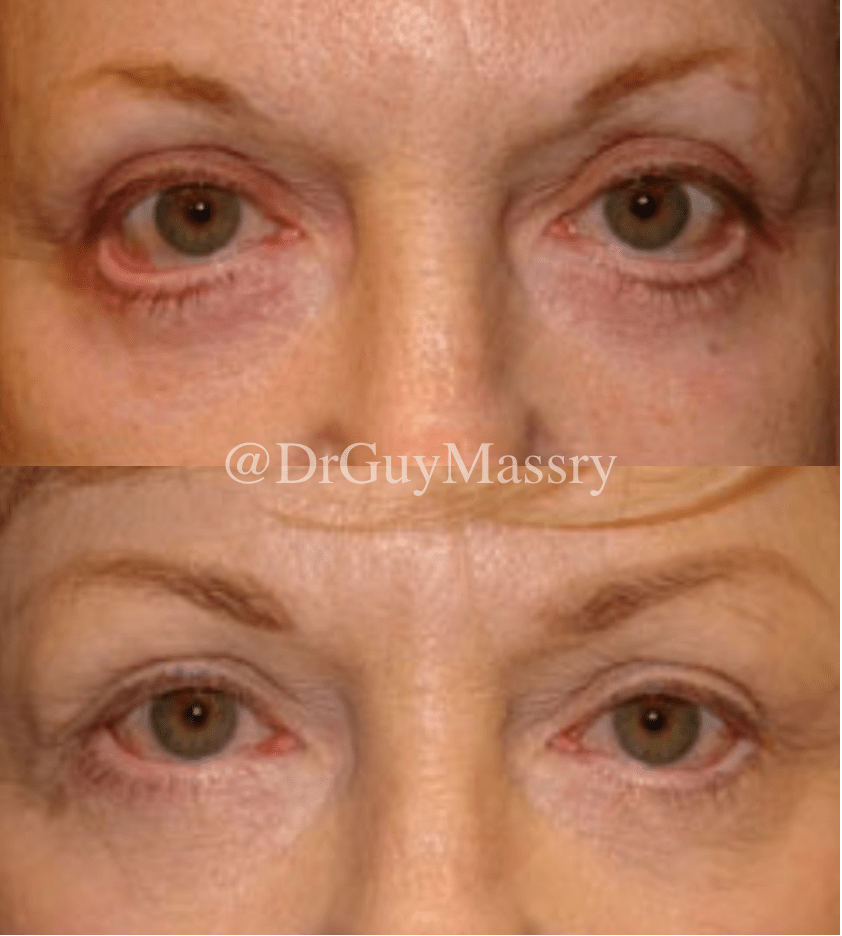 Lower lid retraction surgery Dr. Guy Massry