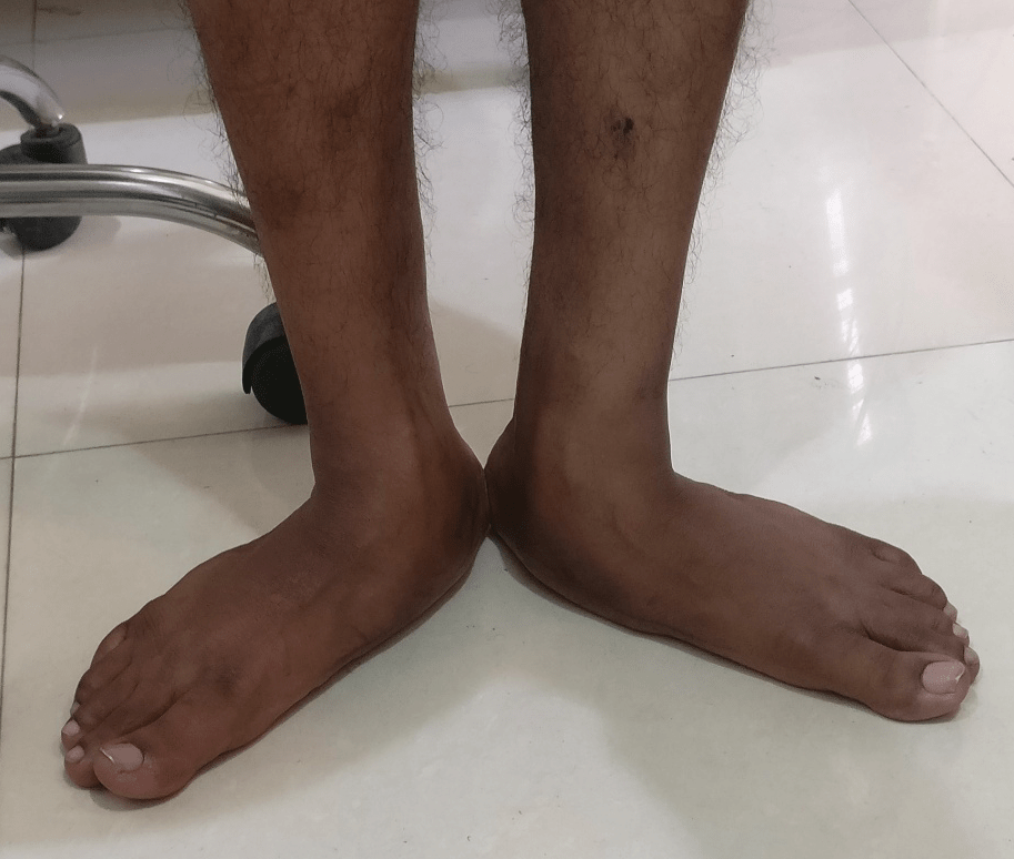 Foot Treatment Surgeon for Flat Feet Surgery in Noida