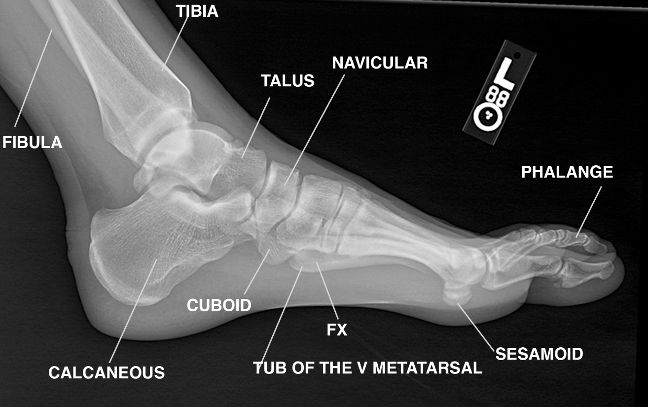 Ankle Impingement Treatment in Delhi Dr. Hitin Mathur