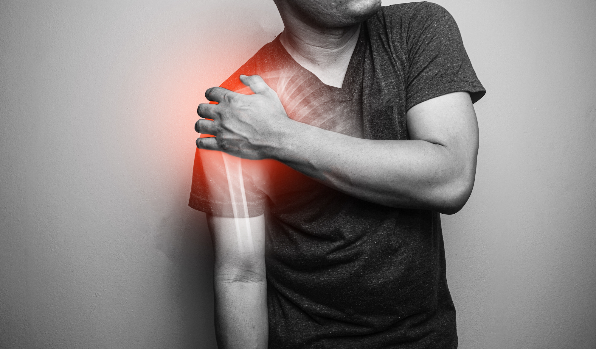 Common Questions About Fractured Shoulders Kyle McClintock, DO