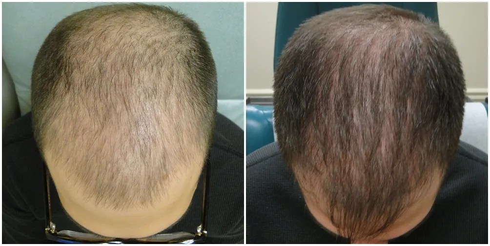 PRP for Hair Loss Dr MediSpa Award Winning Clinics