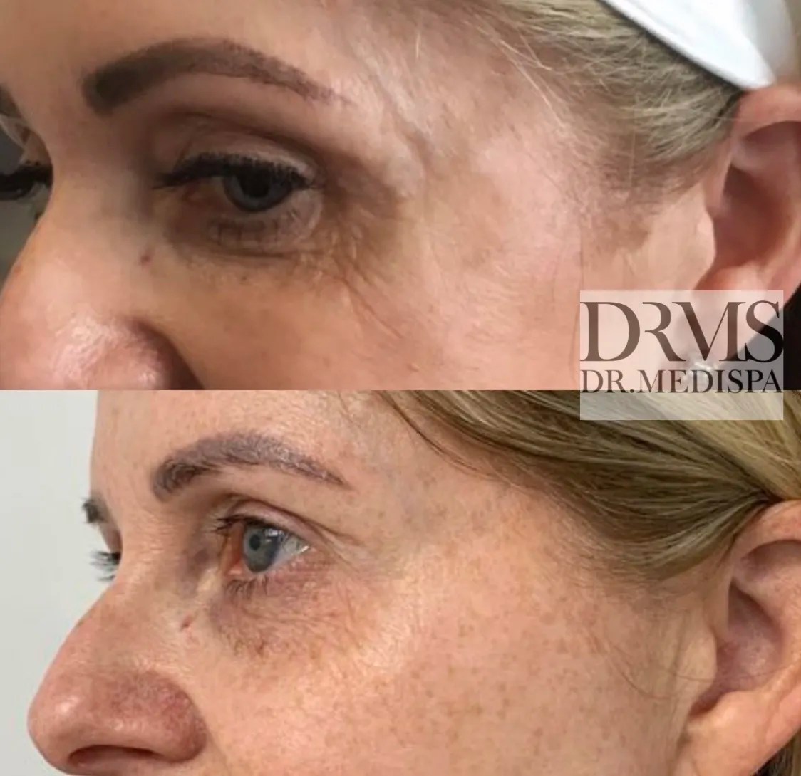 Harmony ClearLift™ laser treatment Dr MediSpa Award Winning Clinics