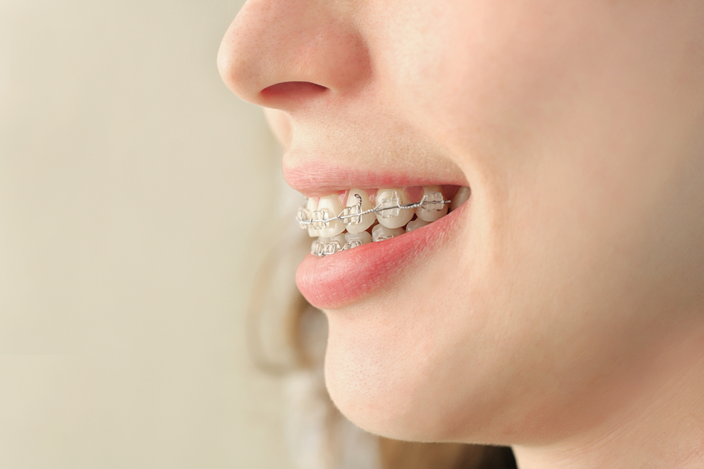 Teeth Braces Bring Extra Benefits for Your Health Dr. Mick