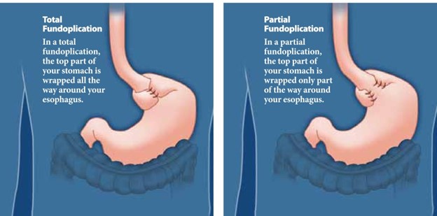 REFLUX(GERD), HIATAL HERNIA, DIAPHRAGMATIC HERNIA Dr. Mike Liang