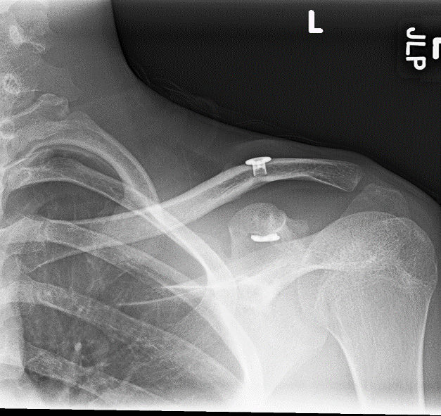 Shoulder Dislocation Shoulder Separation Vail, Aspen, Denver CO
