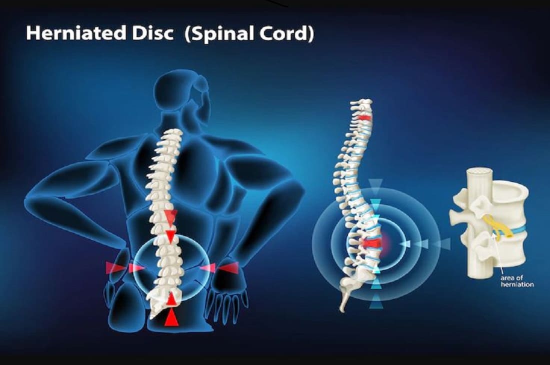 Disc Herniation Treatment in Orange Chiropractic Care