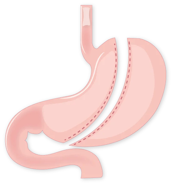 Laparoscopic Sleeve Gastrectomy DR. M. KHRAIS CENTRE
