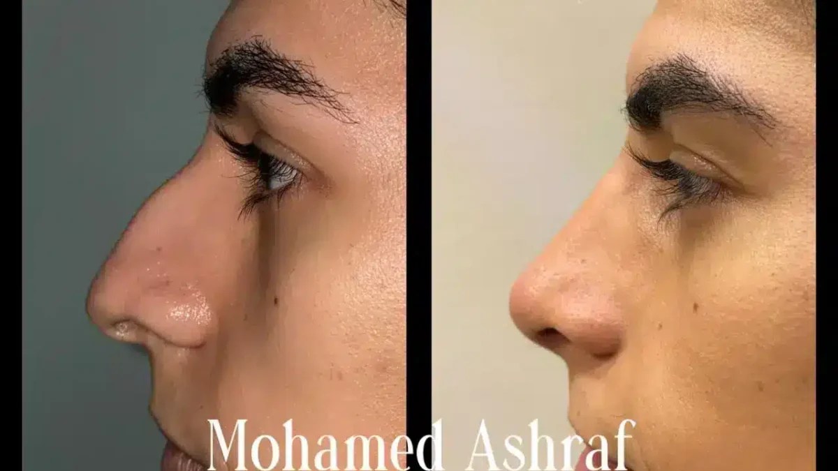 How much does a Nose job cost in Cairo or Egypt? Dr M. Ashraf