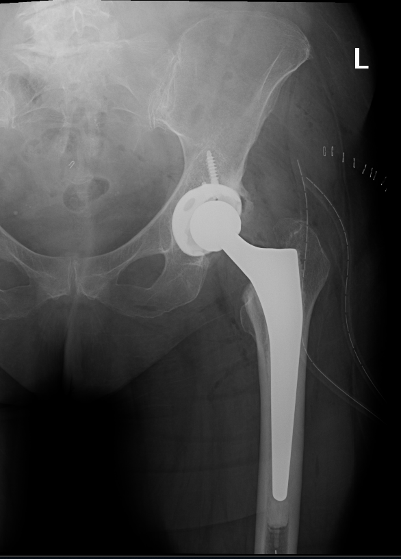 Total Hip Replacement Dr. Mohamed Attia, M.D. PhD