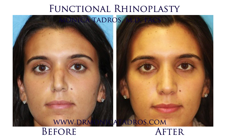 Rhinoplasty Cost in NJ & NYC Average Nose Job Cost